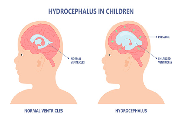 Hydrocephalus