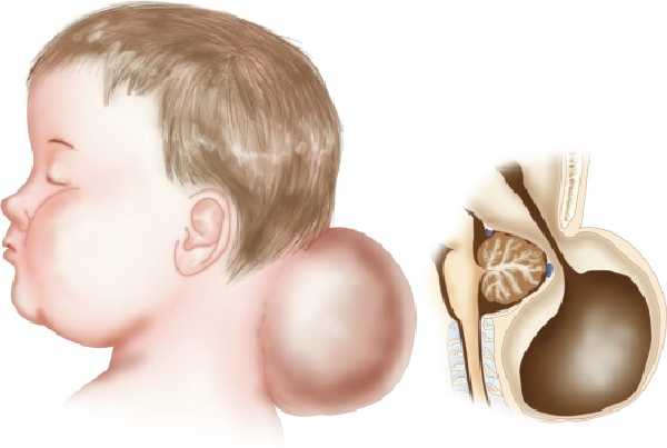 Encephalocele