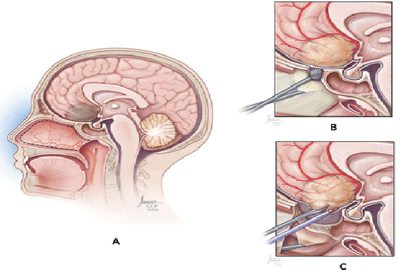 Cranial Endoscopy